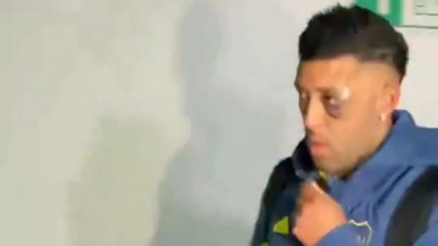 Por qué Janson tenía el ojo lastimado después de la derrota de Boca con Racing