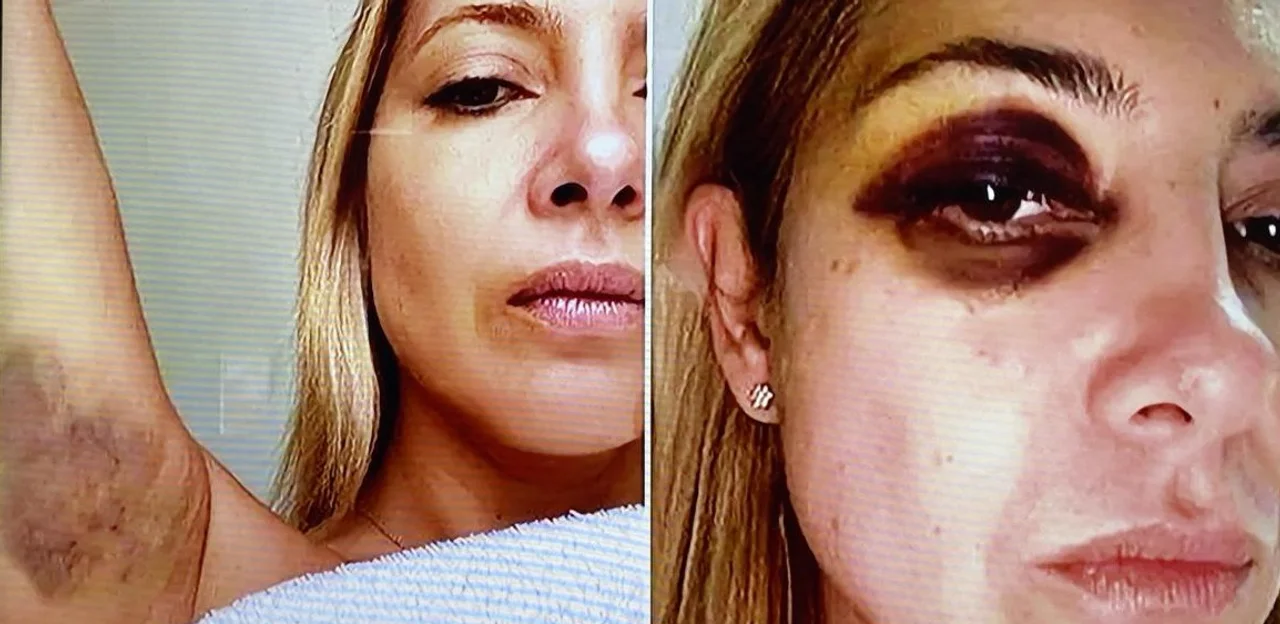 Fabiola Yañez afirmó que sufrió violencia física por parte de Alberto Fernández: “Ese ojo morado existió”